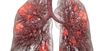 कोरोनाबाट निको भएका ९० प्रतिशतको फोक्सो ड्यामेज